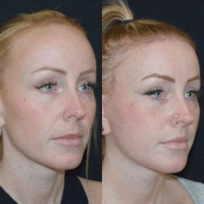 before-after photo tightening-of-facial-skin-facelift