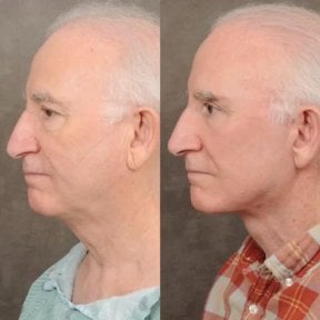 before-after photo tightening-of-facial-skin-facelift