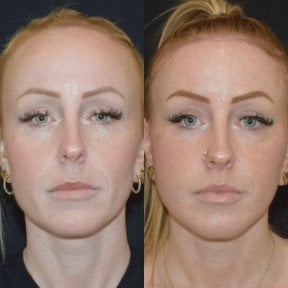 before-after photo tightening-of-facial-skin-facelift