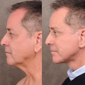before-after photo tightening-of-facial-skin-facelift
