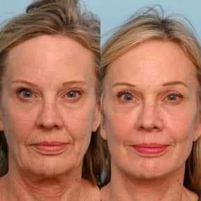 before-after photo tightening-of-facial-skin-facelift