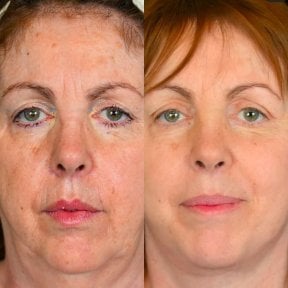 before-after photo tightening-of-facial-skin-facelift