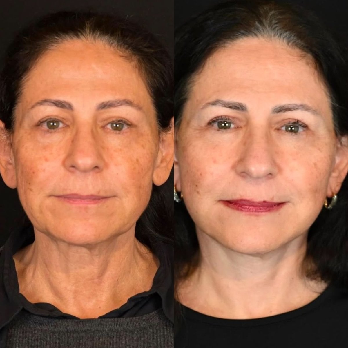 Facelift before and after results at Dr. Alexandro Aguilera - Plastic Surgery, facial rejuvenation