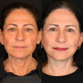 before-after photo tightening-of-facial-skin-facelift