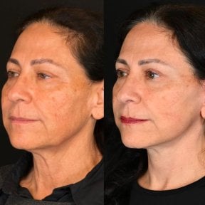 before-after photo tightening-of-facial-skin-facelift