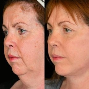 before-after photo tightening-of-facial-skin-facelift