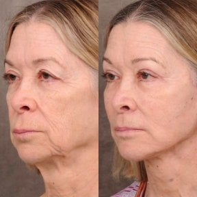 before-after photo tightening-of-facial-skin-facelift