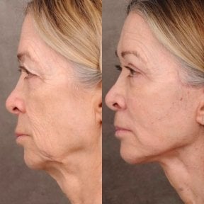 before-after photo tightening-of-facial-skin-facelift