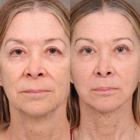 before-after photo tightening-of-facial-skin-facelift