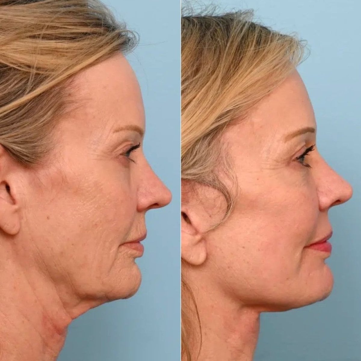 نتائج شد الوجه قبل وبعد في Dr. Alexandro Aguilera - Plastic Surgery، رفع واضح للرقبة