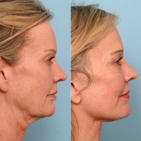 before-after photo tightening-of-facial-skin-facelift