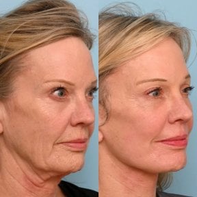 before-after photo tightening-of-facial-skin-facelift