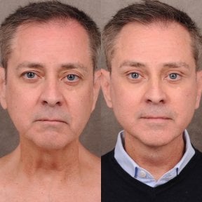 before-after photo tightening-of-facial-skin-facelift