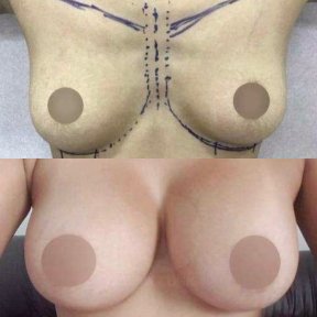 before-after photo breast-augmentation
