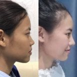 Before and after rhinoplasty results, improved nose profile and facial harmony