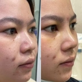 Before and after rhinoplasty results, nose reshaping with improved contour and symmetry