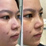 Before and after rhinoplasty results, nose reshaping with improved contour and symmetry