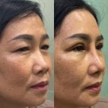 Before and after rhinoplasty results, improved nose shape and contour for natural look