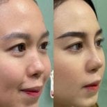 Before and after rhinoplasty results, improved nose shape and profile enhancement
