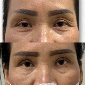 before-after photo upper-and-lower-eyelid-surgery