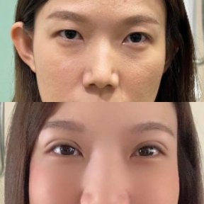 before-after photo upper-and-lower-eyelid-surgery