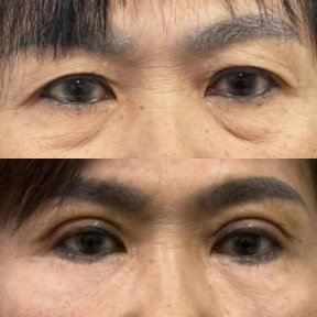 before-after photo upper-and-lower-eyelid-surgery
