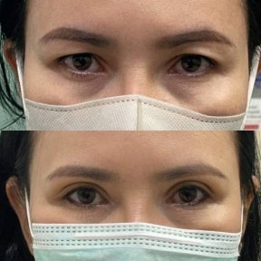 before-after photo upper-and-lower-eyelid-surgery