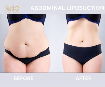 before-after photo vaser-liposuction
