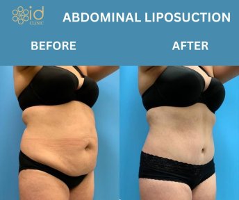 before-after photo vaser-liposuction