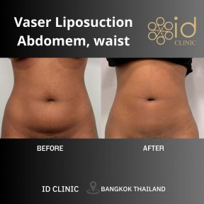 before-after photo vaser-liposuction