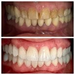 Before and after Hollywood Smile results at Ader Dent Oral and Dental Health Clinic, whiter teeth