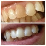 Before and after laser teeth whitening results at Ader Dent Oral and Dental Health Clinic