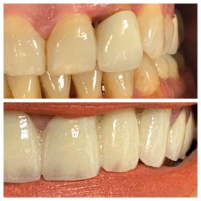 before-after photo zirconia-crown-installation