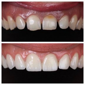 before-after photo zirconia-crown-installation