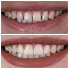 before-after photo zirconia-crown-installation