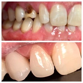 before-after photo zirconia-crown-installation