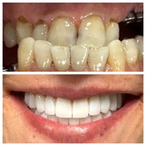before-after photo zirconia-crown-installation
