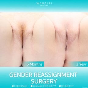 before-after photo male-to-female-mtf-surgery
