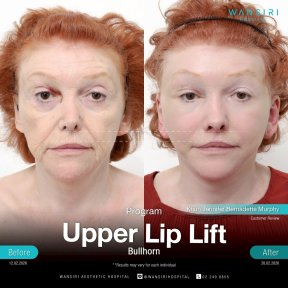 before-after photo lip-lift
