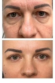 before-after photo blepharoplasty-eyelid