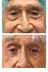 before-after photo blepharoplasty-eyelid