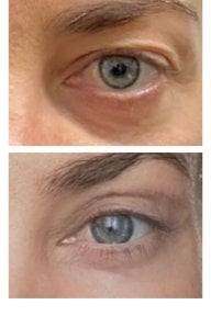before-after photo blepharoplasty-eyelid