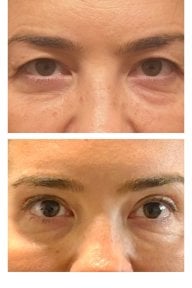 before-after photo blepharoplasty-eyelid