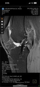 before-after photo therapeutic-arthroscopy-of-the-knee--including-the-necessary-supplies