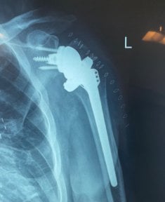 before-after photo shoulder-replacement