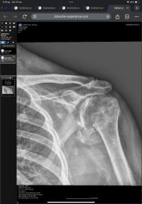 before-after photo shoulder-replacement