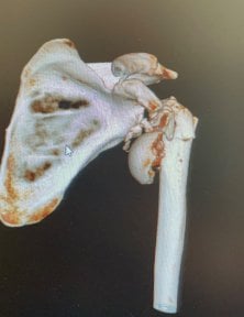 before-after photo shoulder-replacement