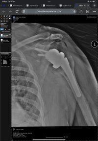 before-after photo shoulder-replacement