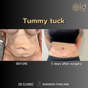 before-after photo abdominoplasty