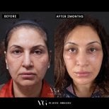 Résultats lifting visage avant/après chez VG Plastic Surgery, rajeunissement visible après 2 mois